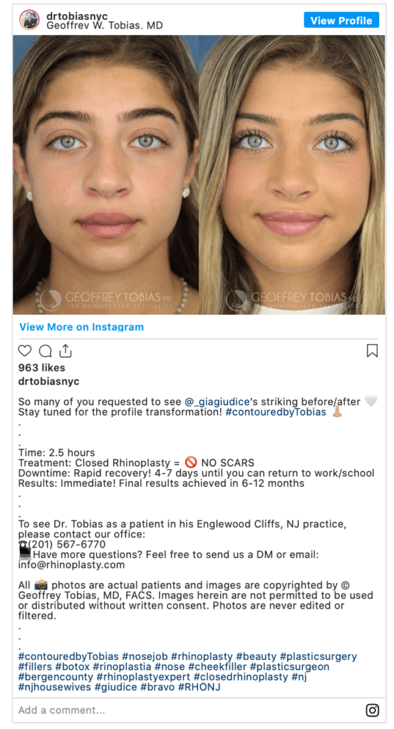 Rhonj See The Before And After Pics From Gia Giudices Nose Job 