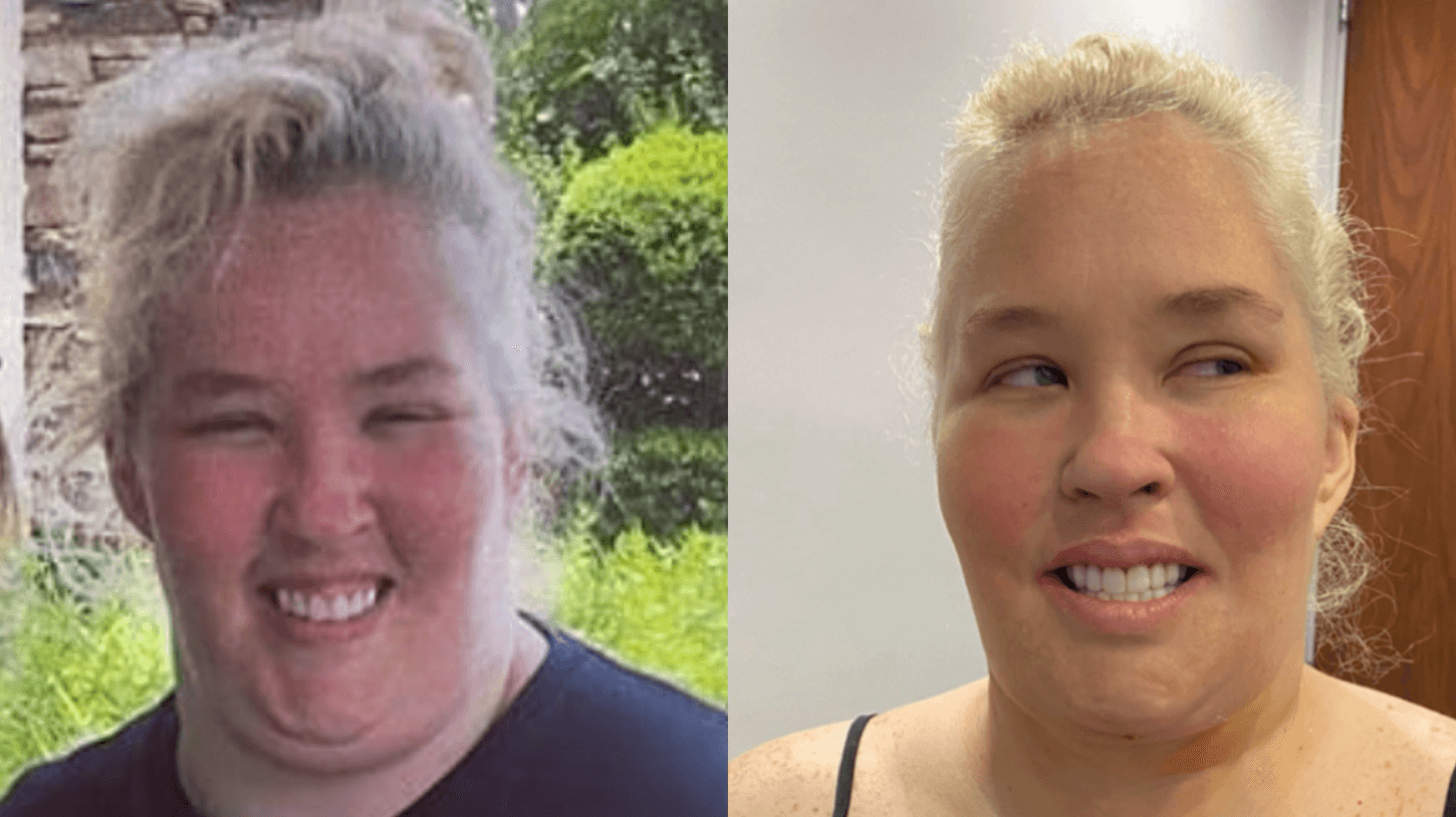 Mama June Unveils New Chin Following 15k Surgery See Before And After Pics