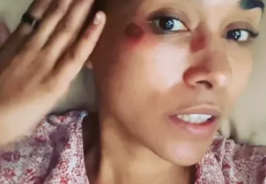 ???RHOP??? Alum Katie Rost Posts Disturbing Battered & Bruised Selfies ???I